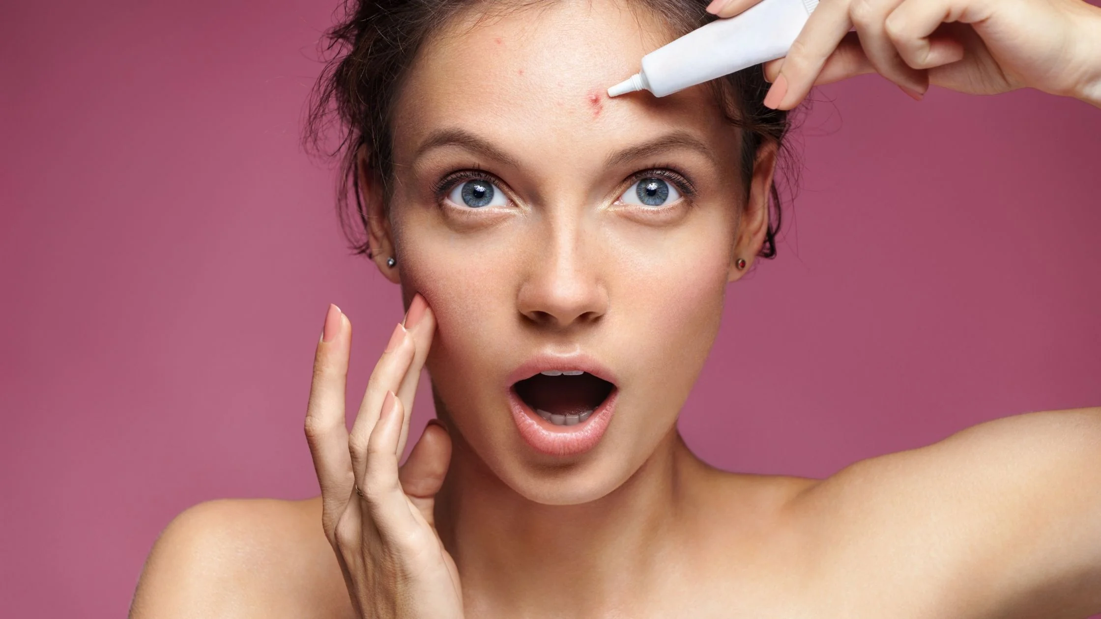 Acné, trucos que si funcionan y que los dermatólogos te esconden