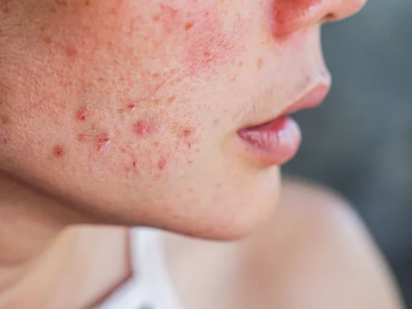 acne Merca2.es