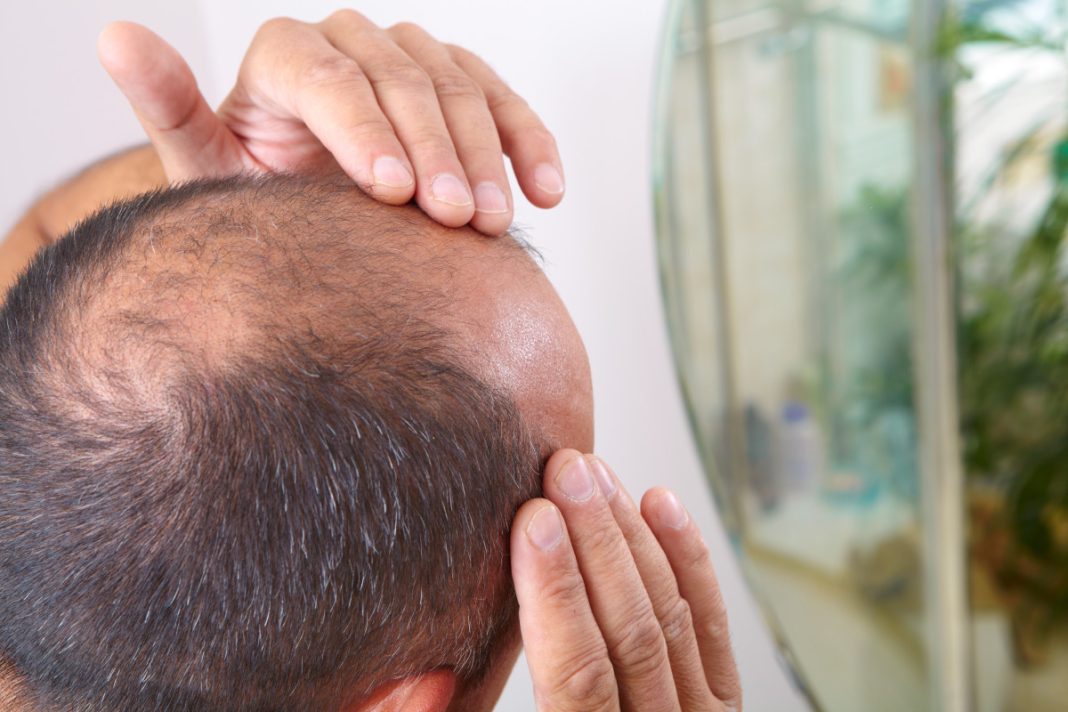 ¡Adiós calvicie! Descubre cómo combatir la alopecia con estos trucos insólitos