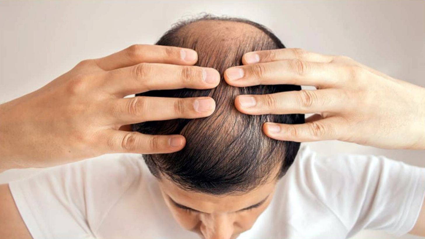 ¡Adiós calvicie! Descubre cómo combatir la alopecia con estos trucos insólitos 3 Merca2.es NUTRICIÓN Y ALOPECIA: ALIMENTANDO EL FOLLÍCULO DESDE DENTRO