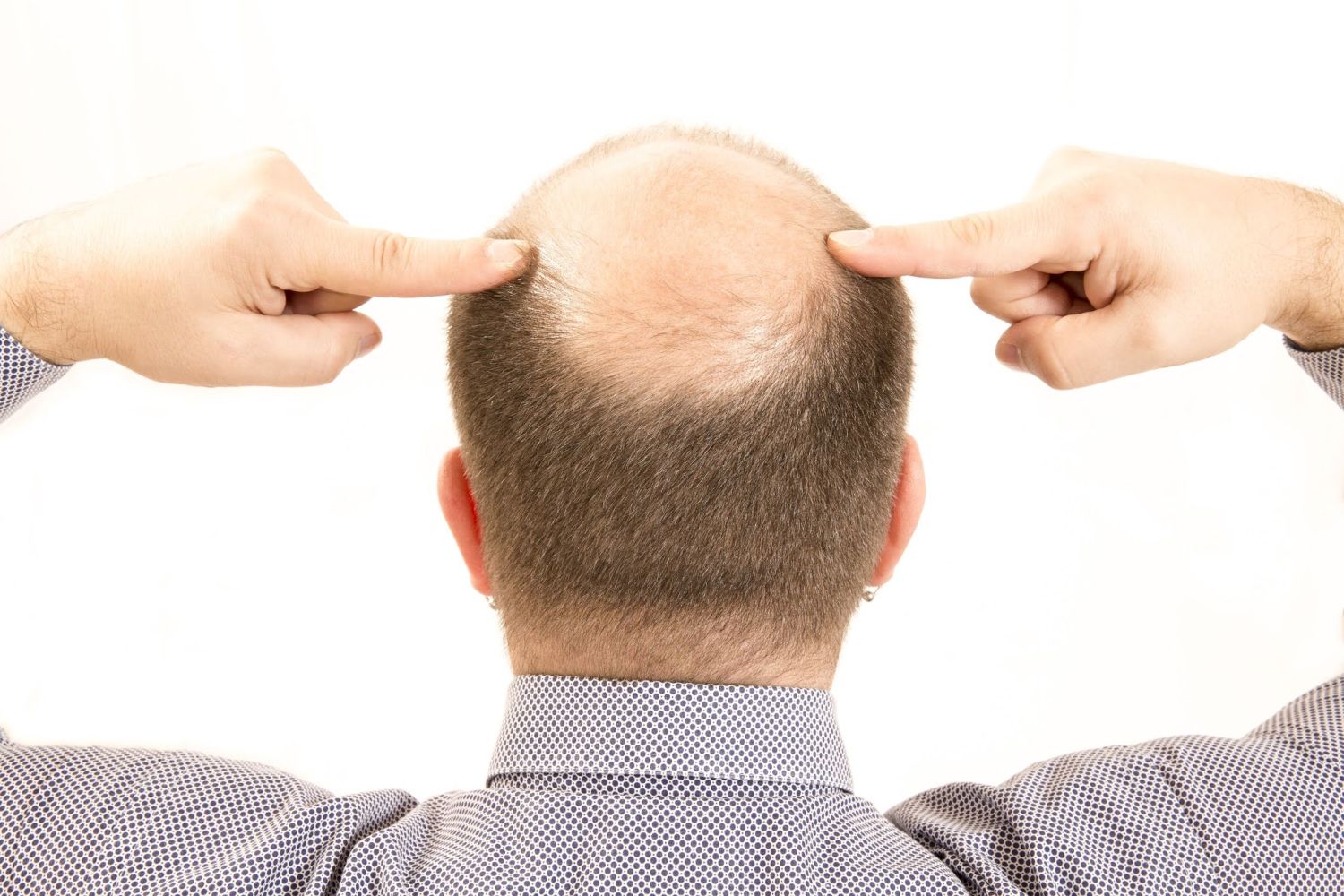 ¡Adiós calvicie! Descubre cómo combatir la alopecia con estos trucos insólitos 1 Merca2.es CAÍDA DEL CABELLO: ENTENDIENDO EL PROBLEMA