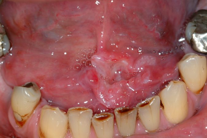 cancer de boca Merca2.es