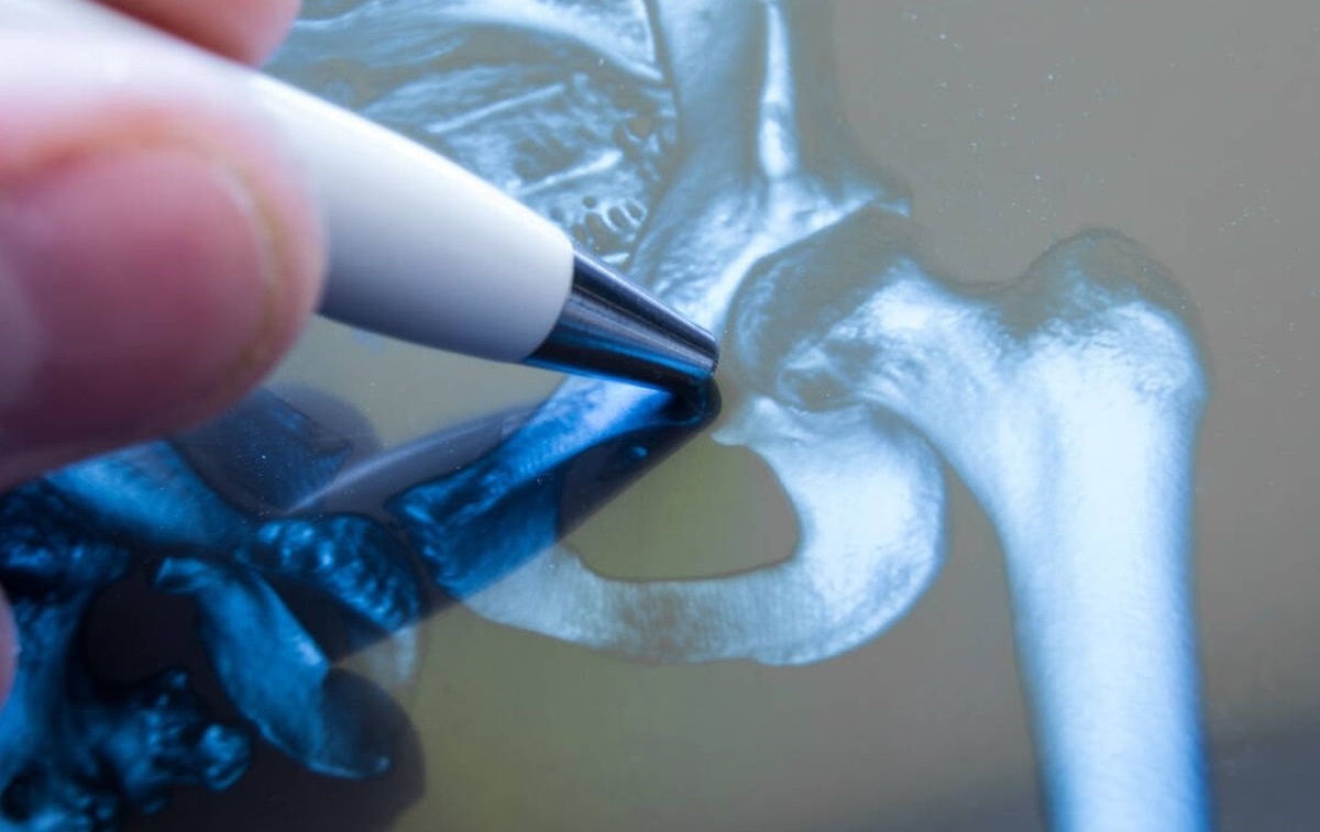 Protocolo de tratamiento quirúrgico precoz de las fracturas de cadera osteoporóticas
