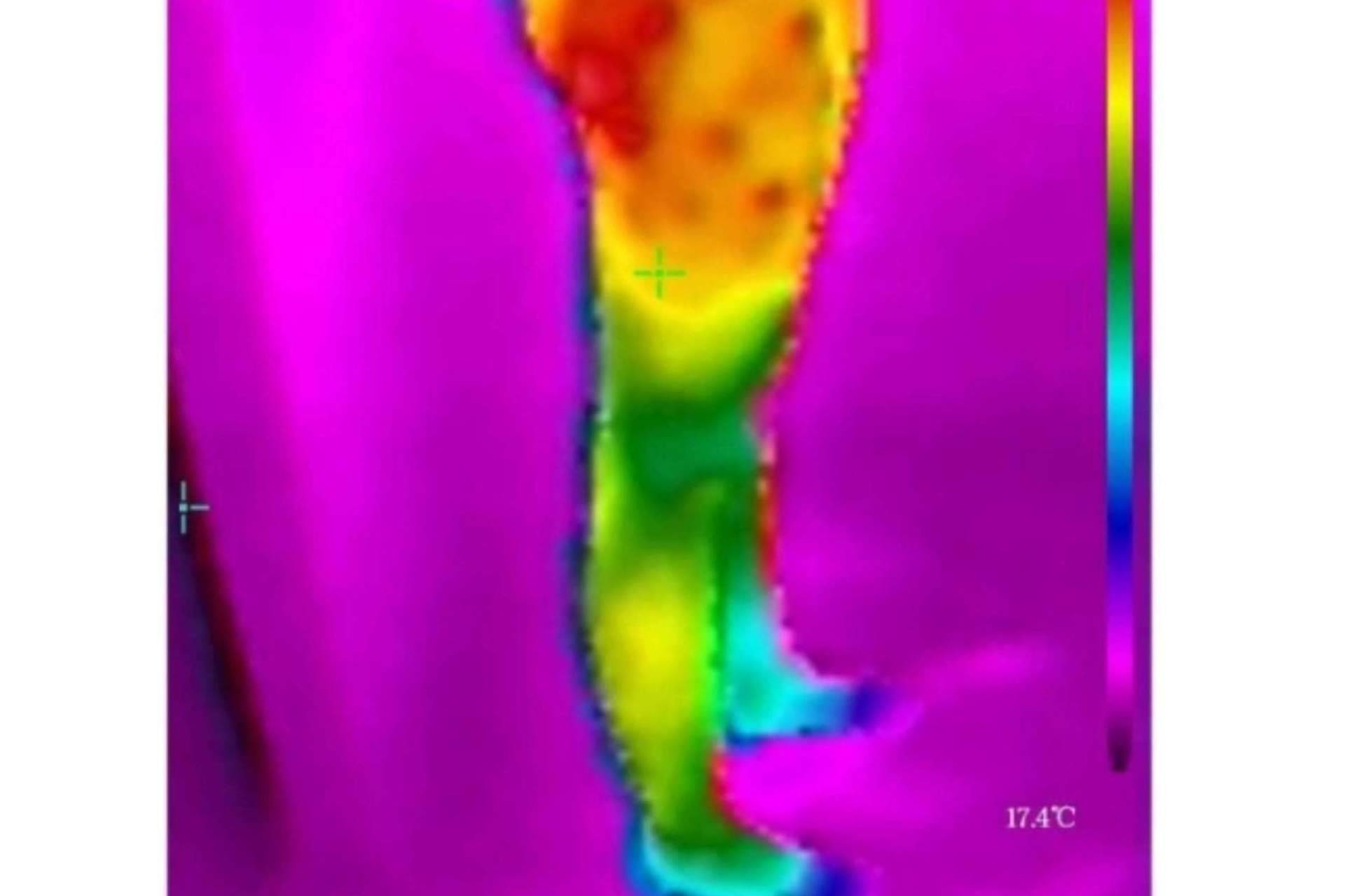 Saber cuál es el tipo de celulitis con la cámara termográfica es posible