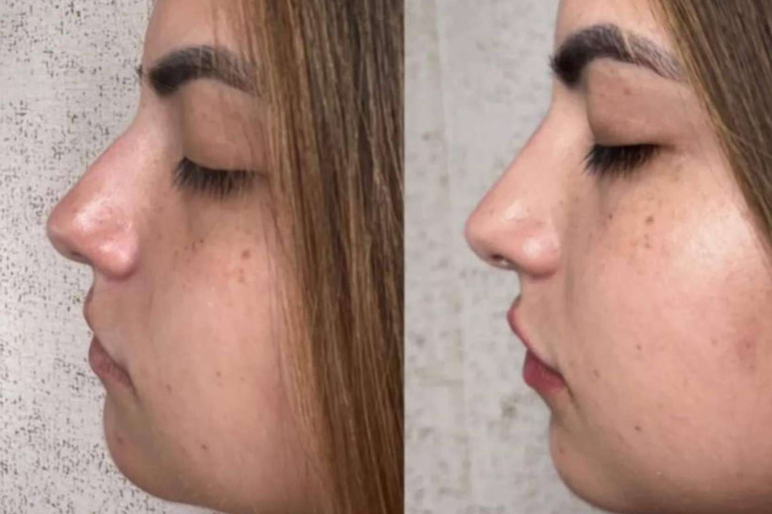 La clínica del Dr. Guidi cuenta con especialistas en rinomodelación en Málaga