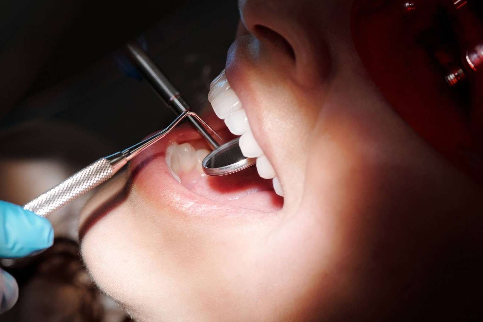Lola Escalante explica qué son las carillas dentales