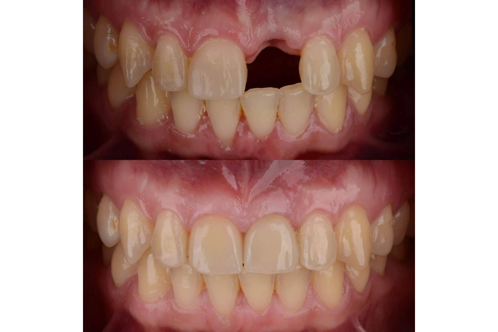 Cuáles son los beneficios de los implantes dentales, por DeltaDent
