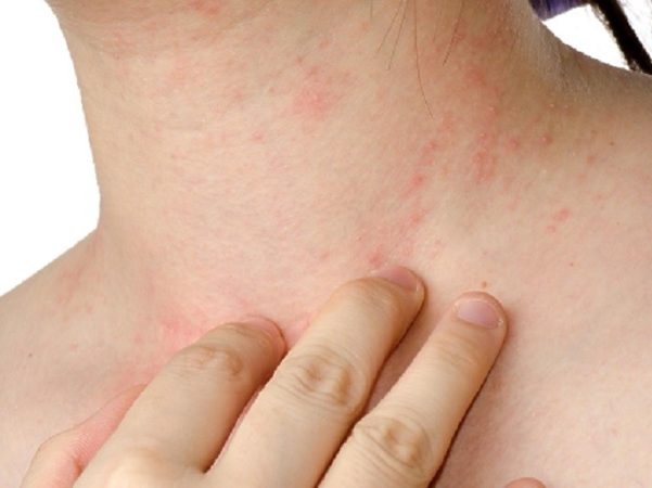 Alergias cutaneas Merca2.es
