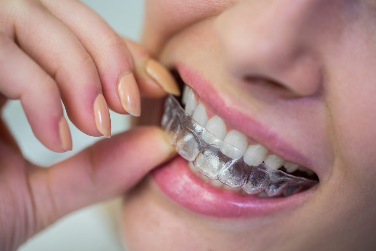 ¿Funciona blanquearse los dientes en casa? La OCU revela toda la verdad sobre estos tratamientos