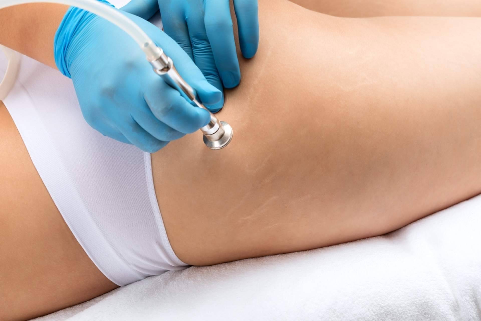 Eliminar estrías con los tratamientos de Centro Estética El Pilar