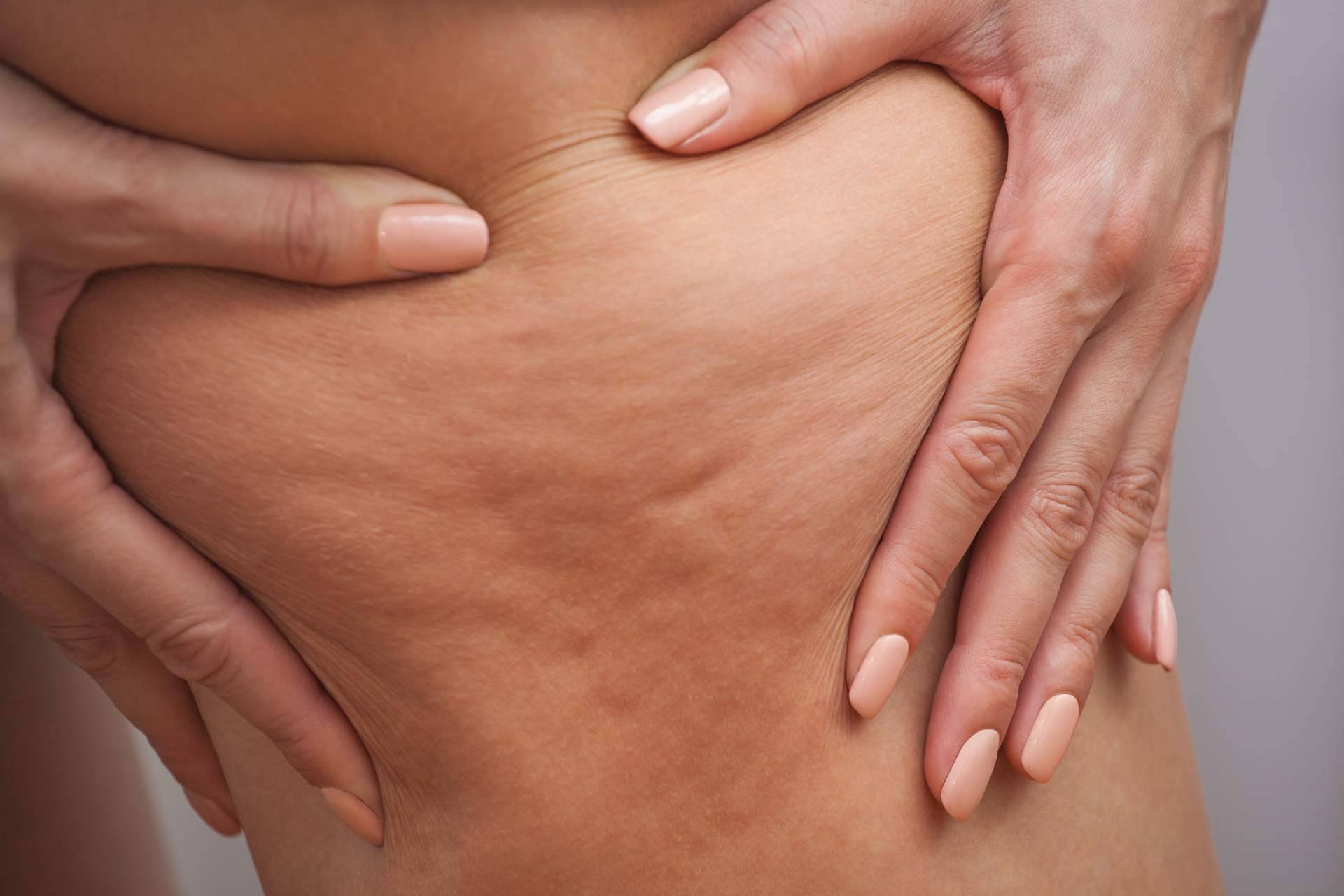 ¿En qué consisten los tratamientos anticelulíticos saludables de Cuerpo Libre?