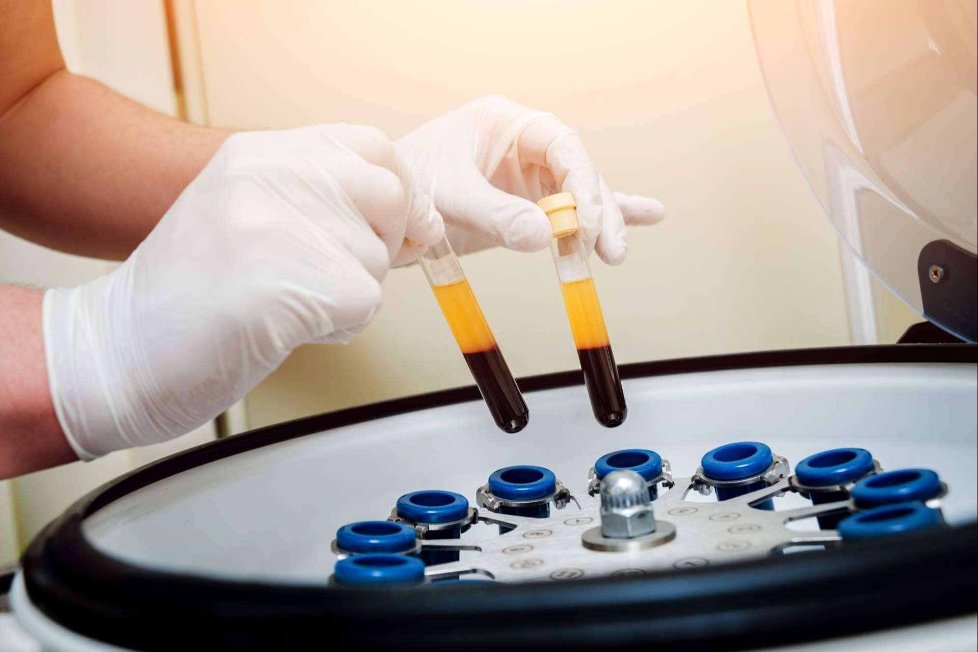 Las ventajas del innovador tratamiento de plasma rico en plaquetas de Centro Estética El Pilar