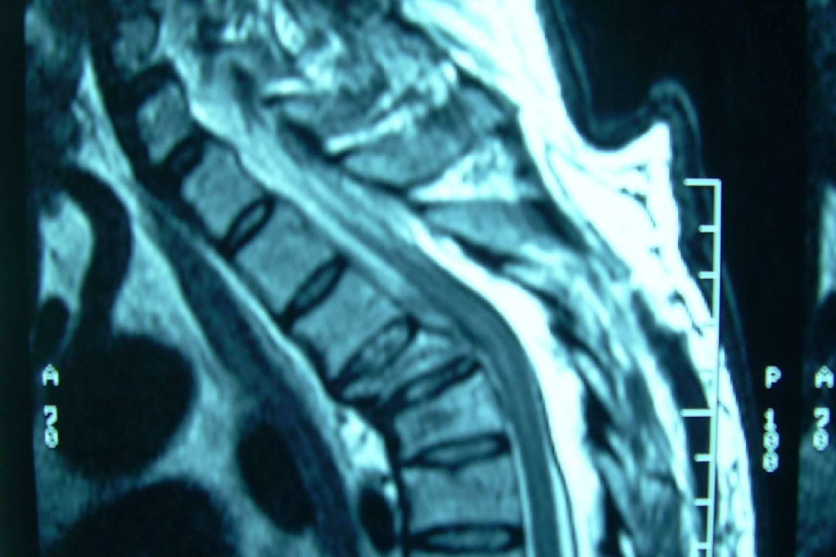 Las fracturas vertebrales, por Neurocirugía Galarza