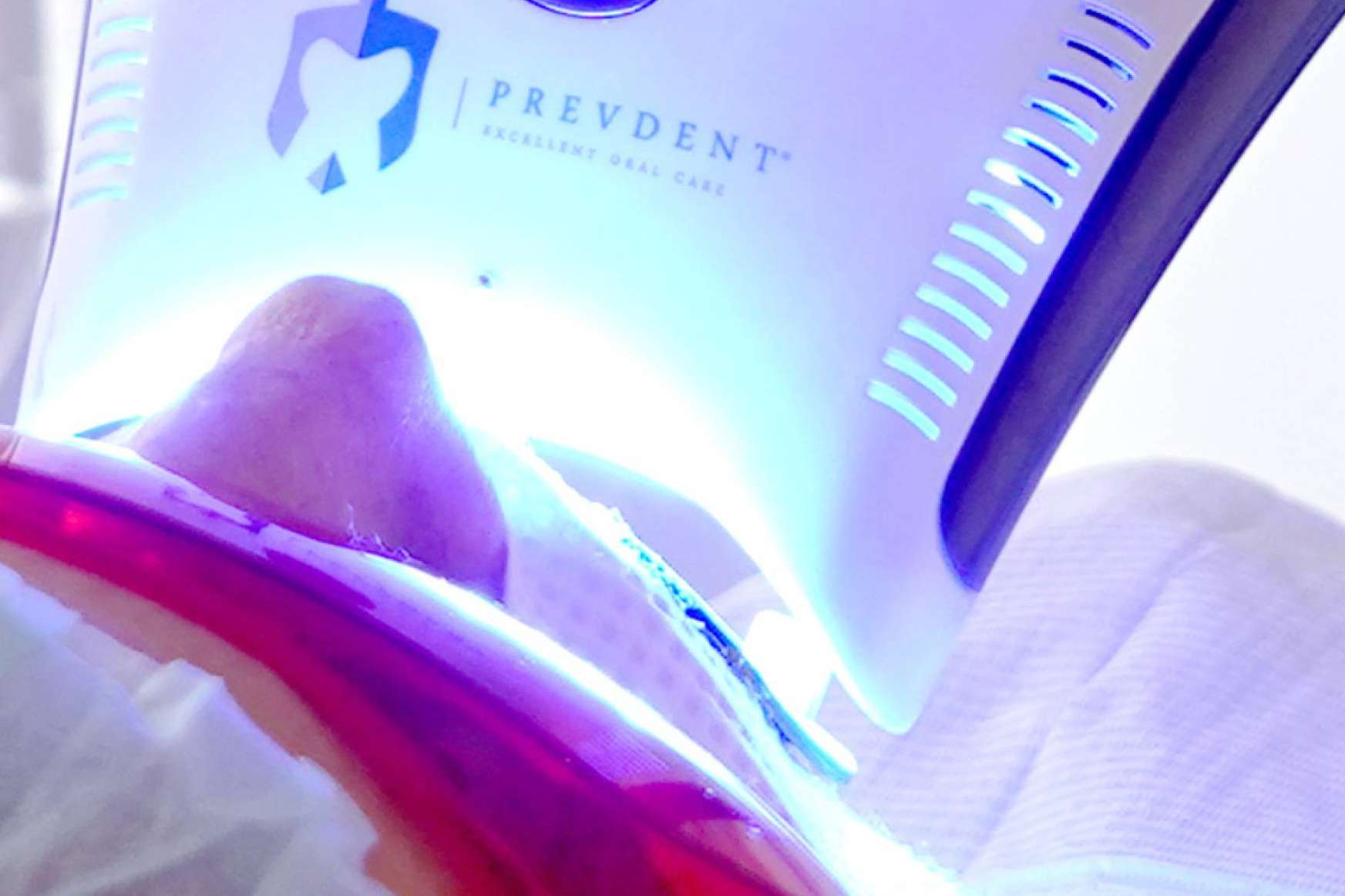 Blanqueamiento dental avanzado con luz LED para una apariencia radiante
