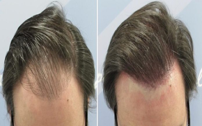 implante de pelo