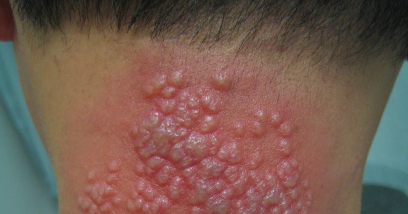 ¿QUÉ ES EL HERPES ZÓSTER?