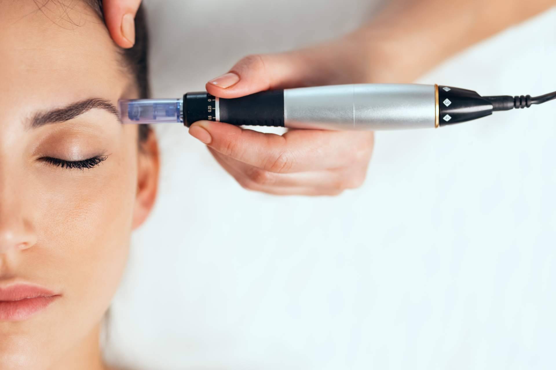 Eliminar pequeñas cicatrices y mejorar el aspecto de la piel con dermapen de G&G Beauty en ojeras y en cicatrices