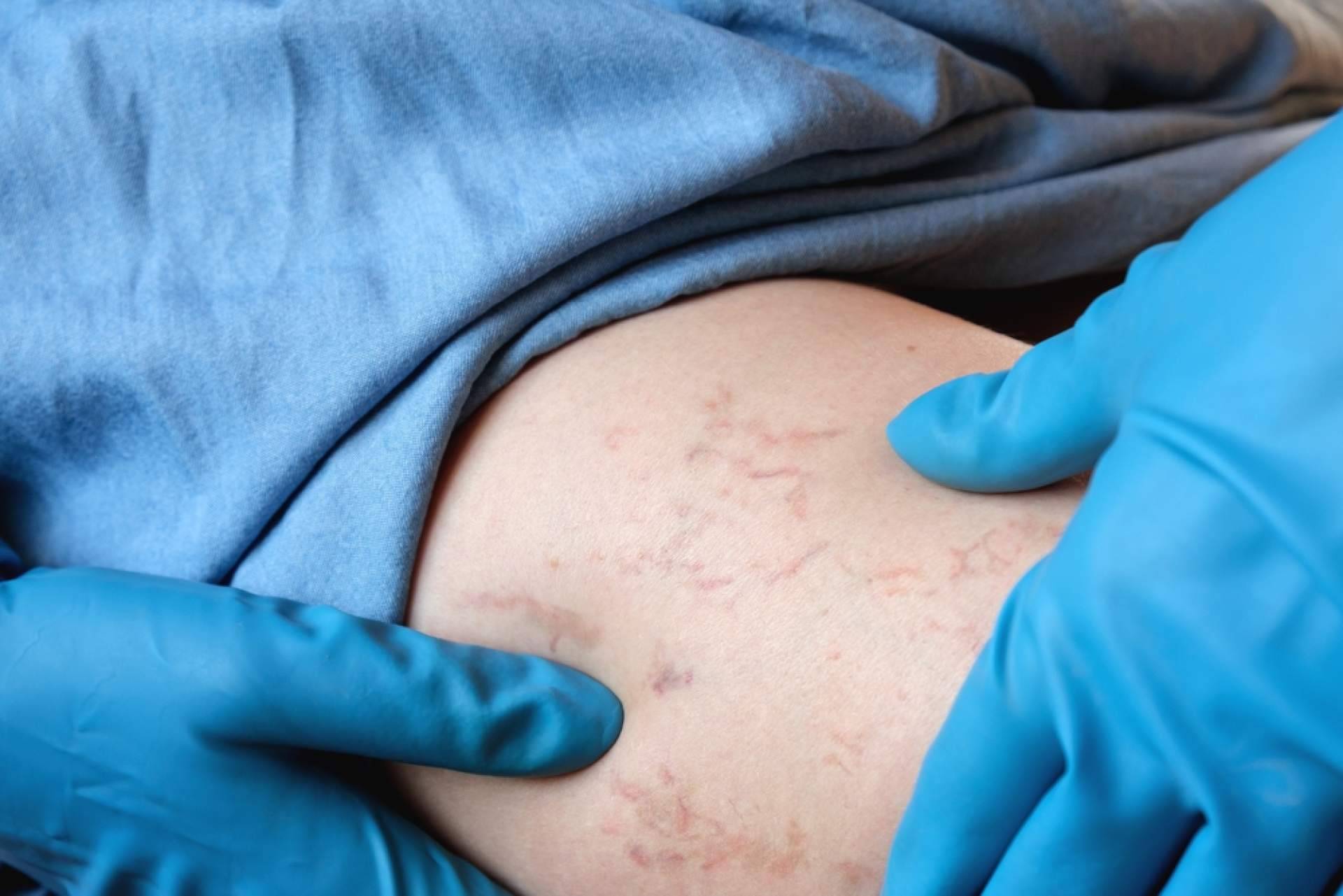Elegansse, especialistas en la eliminación de varices