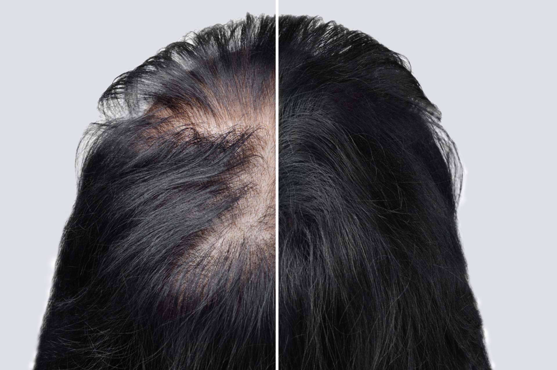 Someterse a los tratamientos para la alopecia androgénica de Saw Palmetto