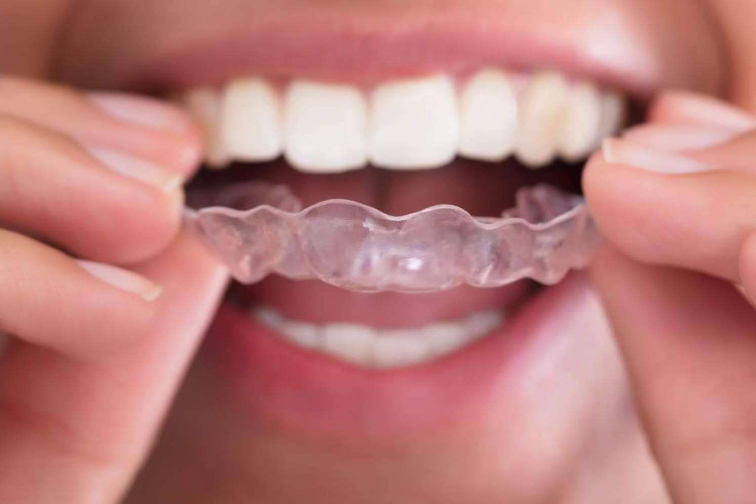 Los especialistas de Lola Escalante Estudio Dental destacan las ventajas de la Ortodoncia Invisible Fast