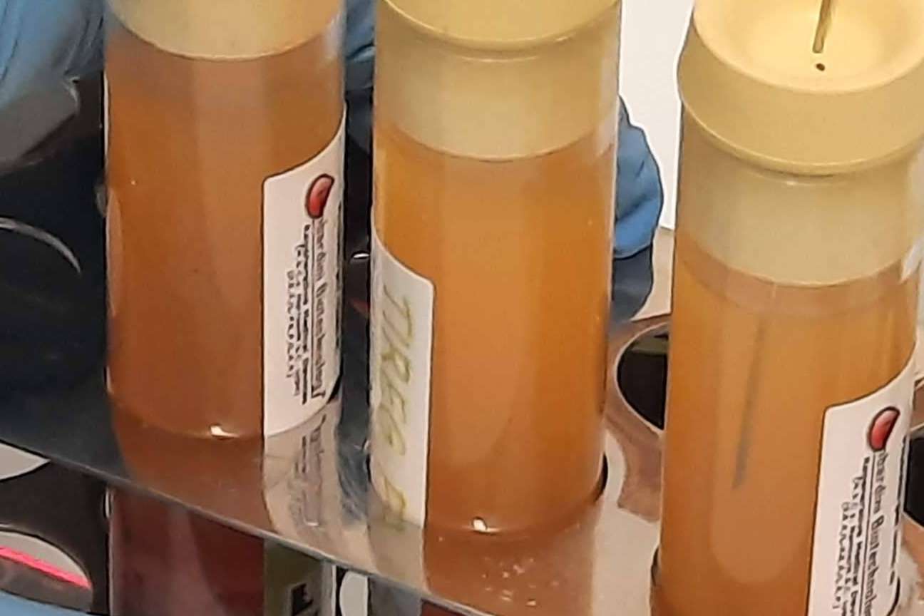 Infiltraciones de plasma rico en plaquetas y células madre, un tratamiento eficaz sin cirugía para artrosis de rodilla