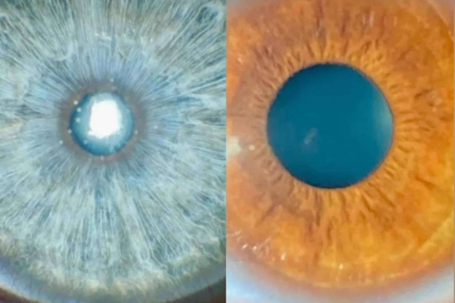 Selección de candidatos para cambio de color de ojos con láser