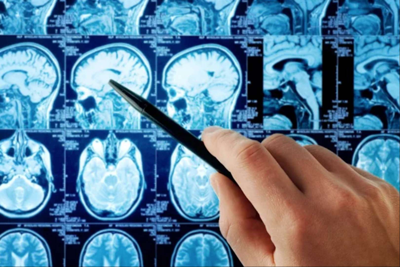 Beneficios de oncothermia en tumor cerebral (Gliomas)