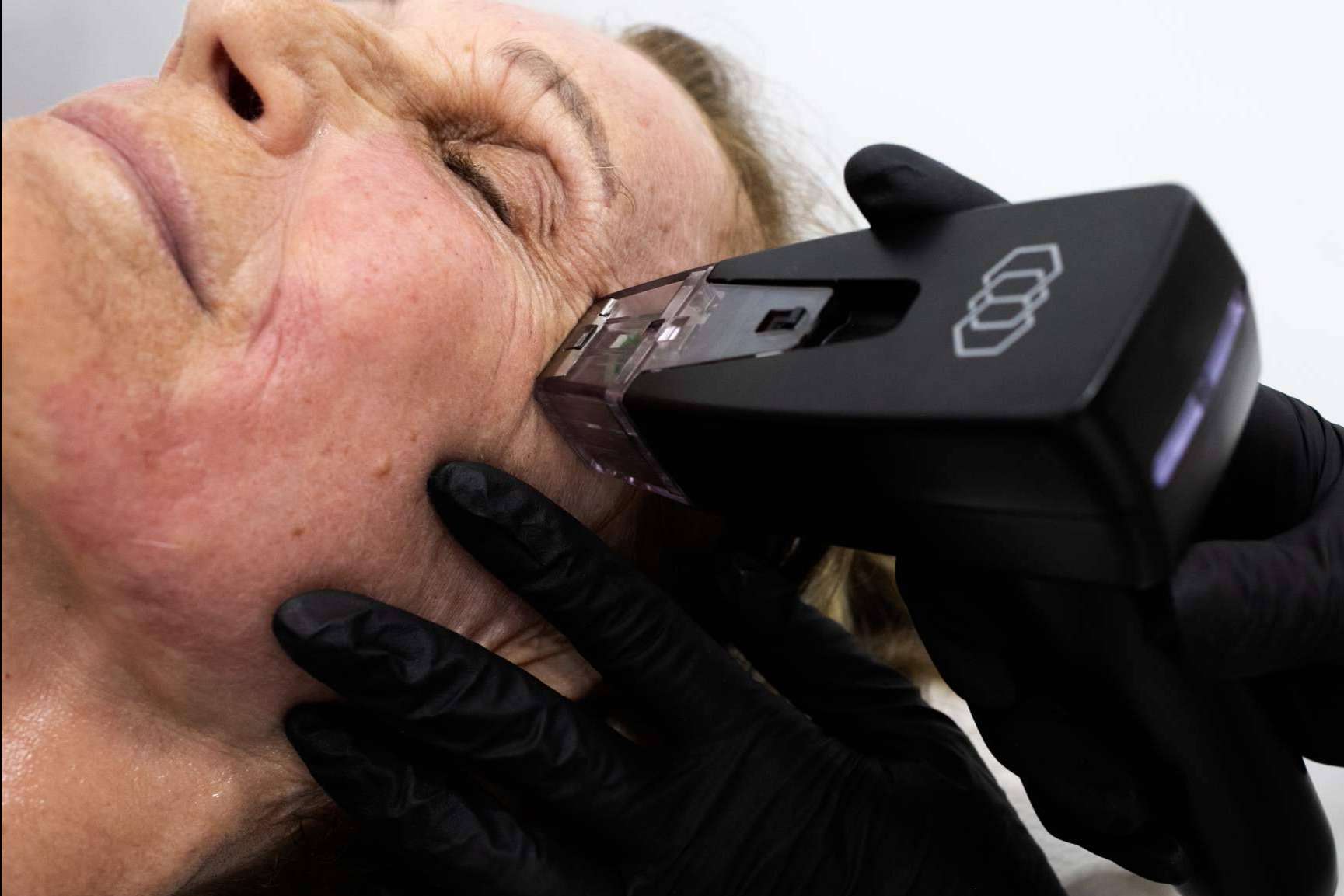 Tratamiento rejuvenecedor Morpheus8 Facial y Corporal de la mano de la Clínica BK
