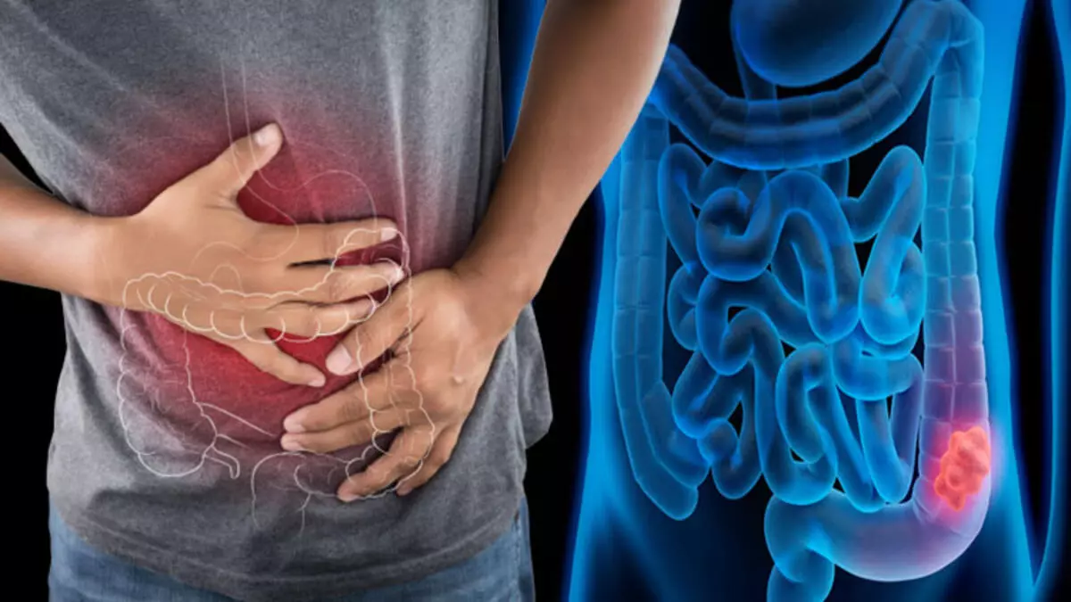 5 alimentos para desinflamar el colon de forma natural 2 Merca2.es REMEDIOS DEL HUERTO: FRUTAS Y VERDURAS ANTIINFLAMATORIAS