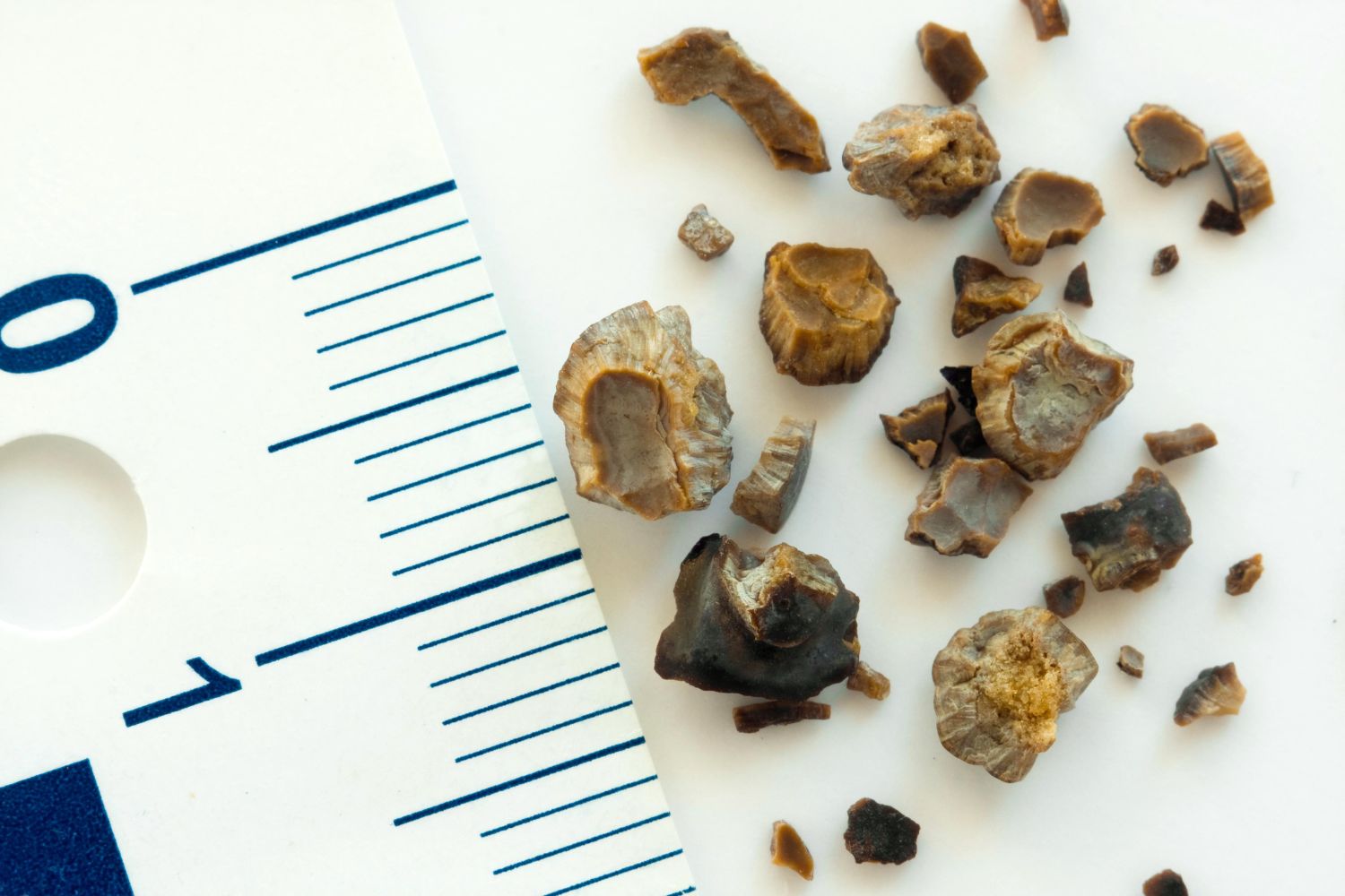 5 alternativas naturales más eficaces para eliminar las piedras en el riñón