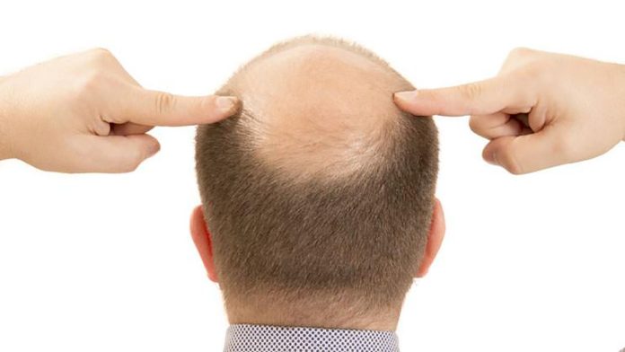 Adiós a la calvicie: Así es como Olistic detiene la caída del cabello de forma natural