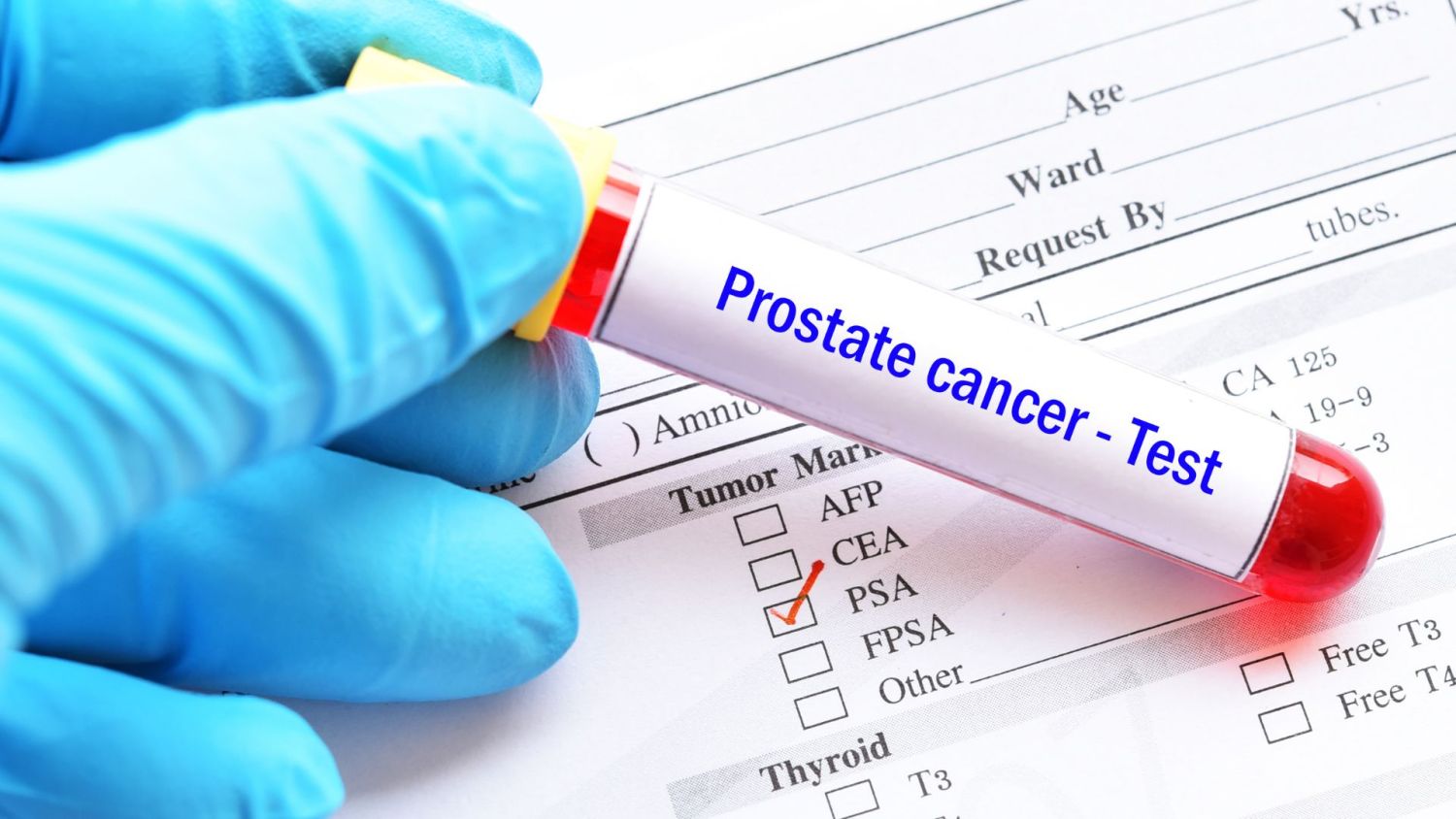 Con un solo examen averigua si sufres de cáncer de próstata