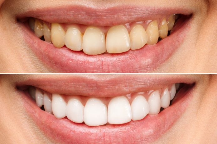 Blanquea tus dientes con esta técnica desde tu hogar y sin perder un montón de pasta en médicos