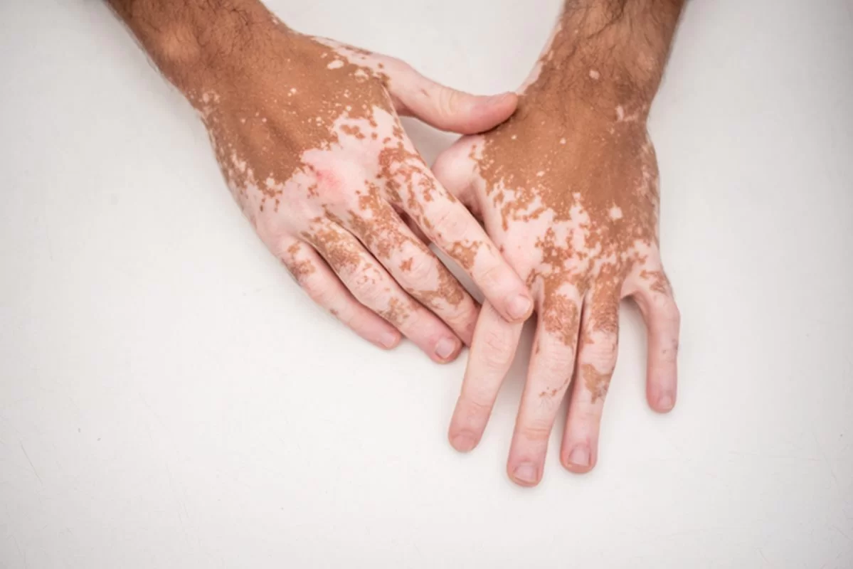 Descubre cómo Opzelura, la crema milagrosa, le dirá adiós al vitíligo 2 Merca2.es Conoce los tipos de vitíligo