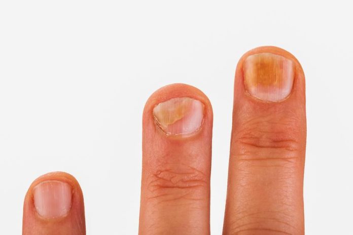 Asi puedes evitar tener las uñas amarillas: el mejor truco si te preocupas por tu estética