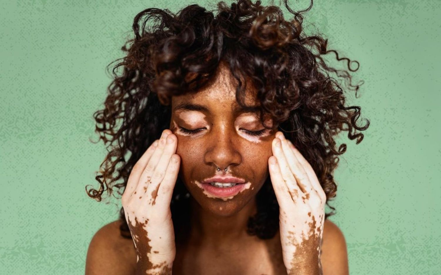 Descubre cómo Opzelura, la crema milagrosa, le dirá adiós al vitíligo