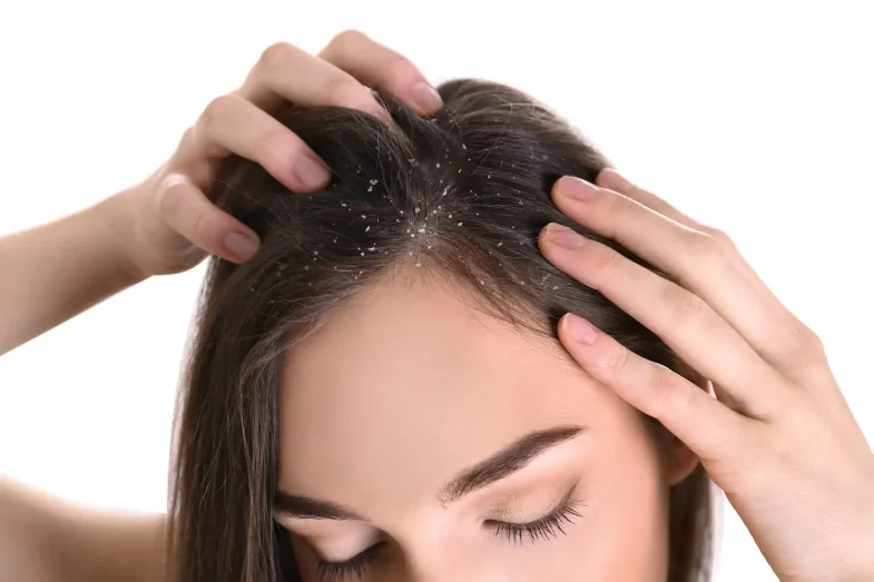 Dile adiós a la caspa, solo necesitas 2 ingredientes