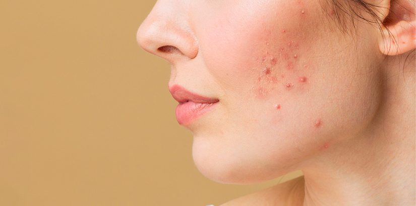 alimentos que producen acne Merca2.es