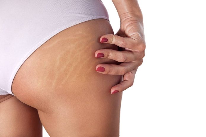 Di adiós a las estrías con este ungüento viral, fácil de hacer y con solo 2 ingredientes