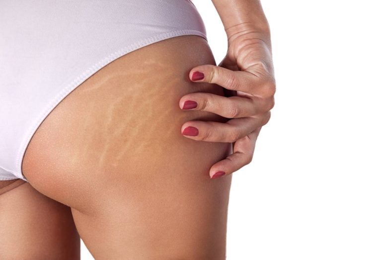 Di adiós a las estrías con este ungüento viral, fácil de hacer y con solo 2 ingredientes