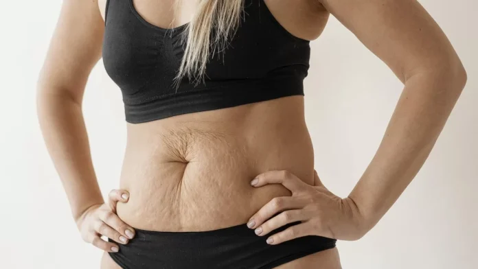 El impresionante efecto del ungüento de la abuela que ayuda a reducir la flacidez abdominal