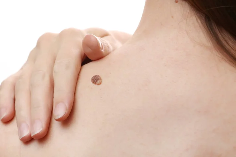 Elimina las verrugas de la piel con este potente remedio natural