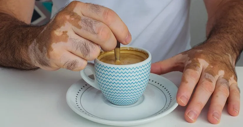 Así se prepara el té milenario para el vitíligo 