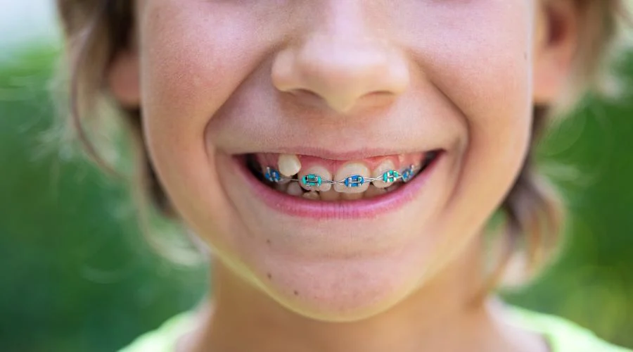 El motivo médico por el que debes colocarle brackets a tus hijos antes de los 12 años