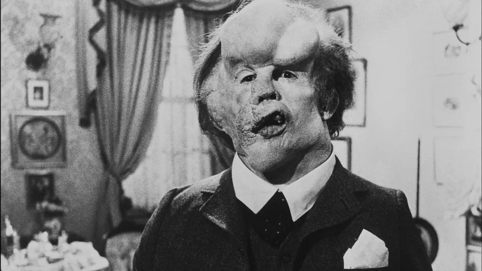 La desgarradora vida de Joseph Merrick, el verdadero Hombre Elefante