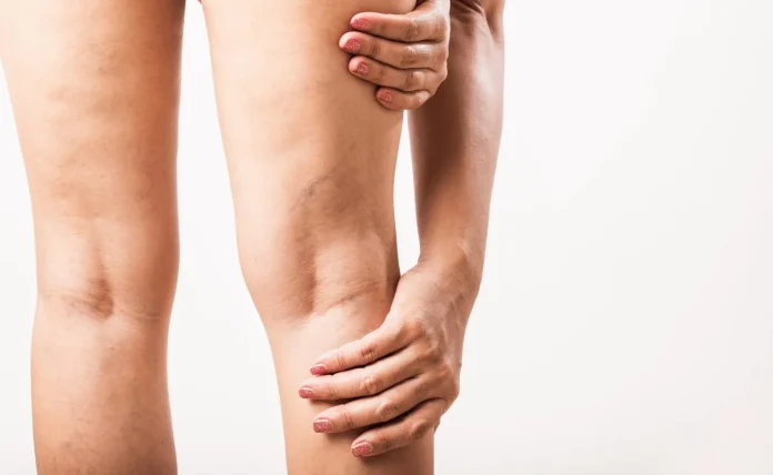 La bebida ancestral que elimina las varices y mejora la circulación