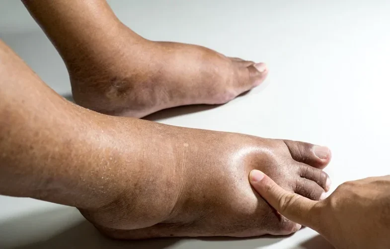 Linfedema: 5 señales de alerta que no debes ignorar
