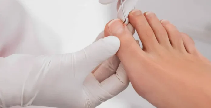 Truco para aliviar las uñas encarnadas en los pies
