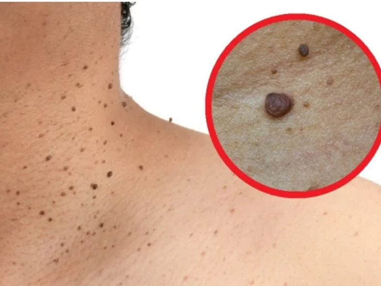 Si tienes estas verrugas en el cuello esto es lo que tienes que hacer