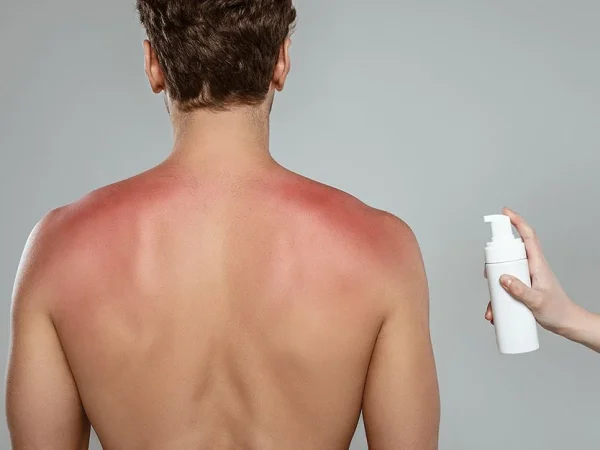 Recupera tu piel después de una quemadura solar con esta crema natural y refrescante 1 Merca2.es Recupera tu piel inmediatamente después de una quemadura solar